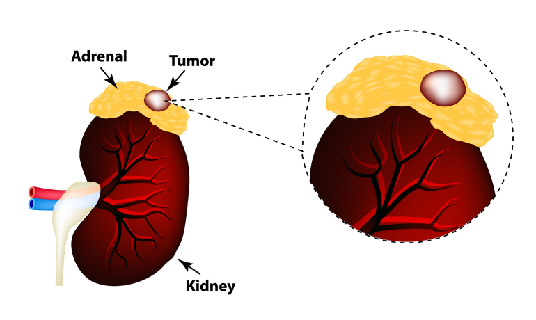 Best Treatment for Adrenal Cancer in Vashi, Navi Mumbai by Dr. Varun V. Agarwal, Best Uro-Oncologist and Robotic Surgeon in Vashi, Navi Mumbai.