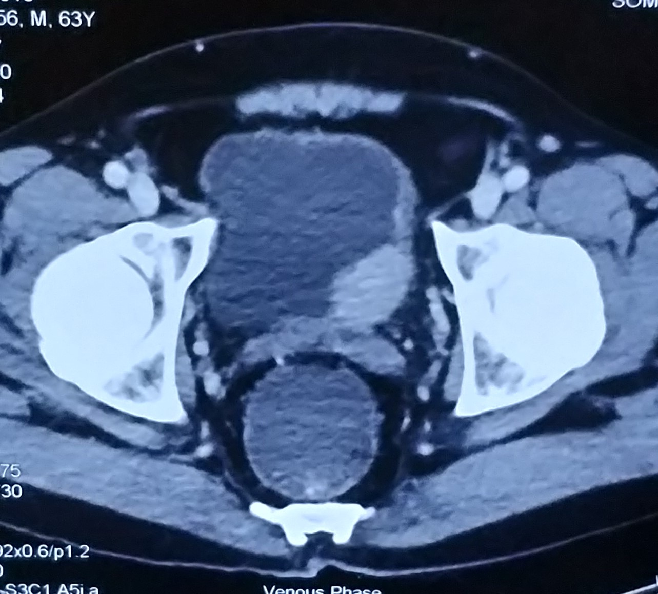 Bladder cancer ct-scan done by Dr. Varun V. Agarwal, Best Uro-Oncologist and Robotic Surgeon in Vashi, Navi Mumbai.