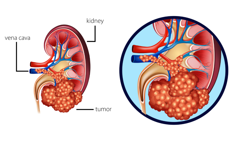 Best Treatment for Kidney Cancer in Vashi, Navi Mumbai by Dr. Varun V. Agarwal, Best Uro-Oncologist and Robotic Surgeon in Vashi, Navi Mumbai.