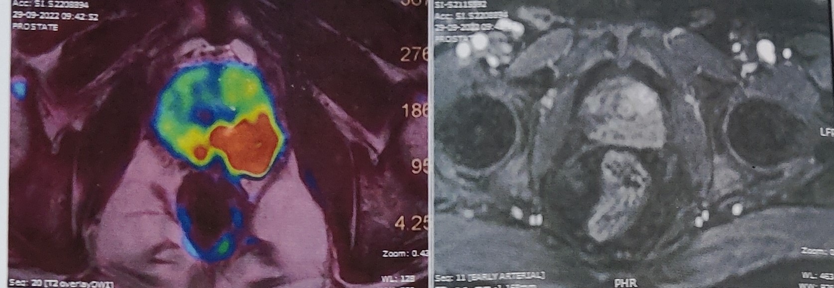 prostate-cancer-mri done by Dr. Varun V. Agarwal, Best Uro-Oncologist and Robotic Surgeon in Vashi, Navi Mumbai.